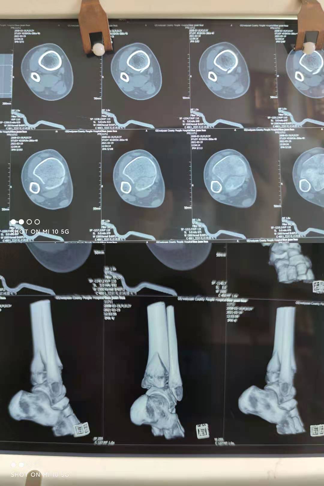 踝关节骨折恢复训练,踝关节骨折几级伤残