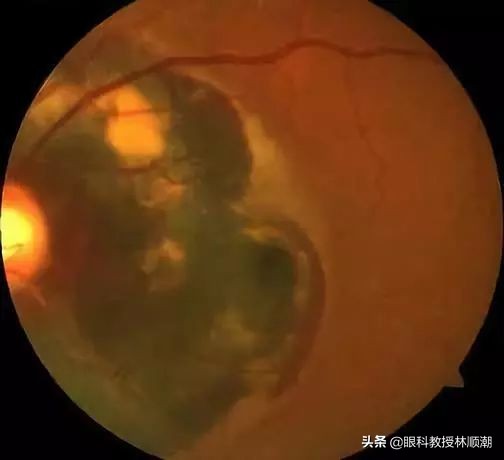 熬夜短时间眼底出血,眼底大出血失明