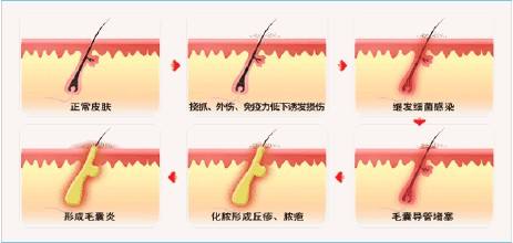 洗护知识在线分享,头皮上出现脓包特别痒怎么办