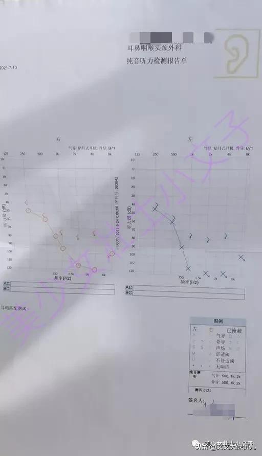 儿童急性中耳炎导致听力下降,8岁孩子急性中耳炎