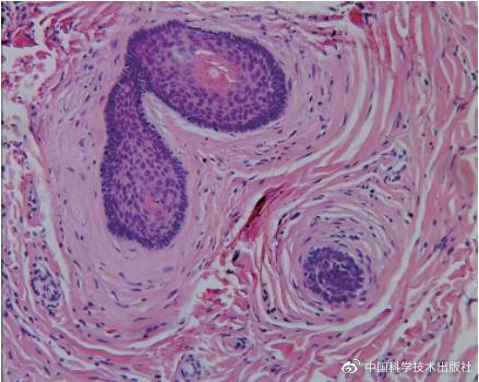 皮肤及附属器源性肿瘤,肿瘤病理诊断书