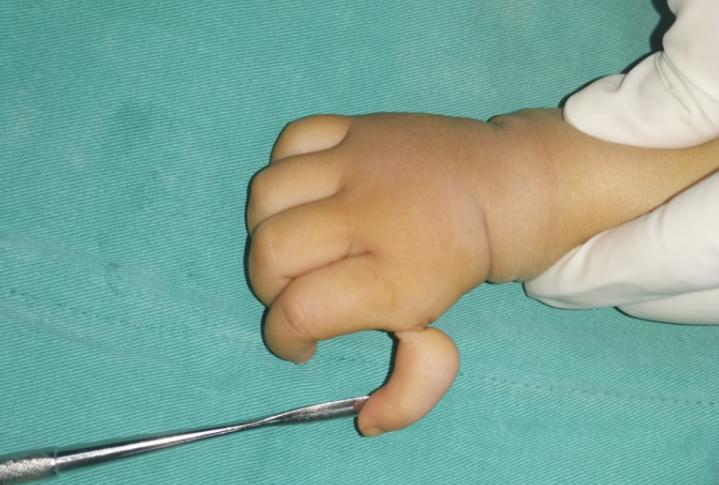 漂浮拇:成功保五指|案例2《半掌骨移植重建术让小女孩“重生”》