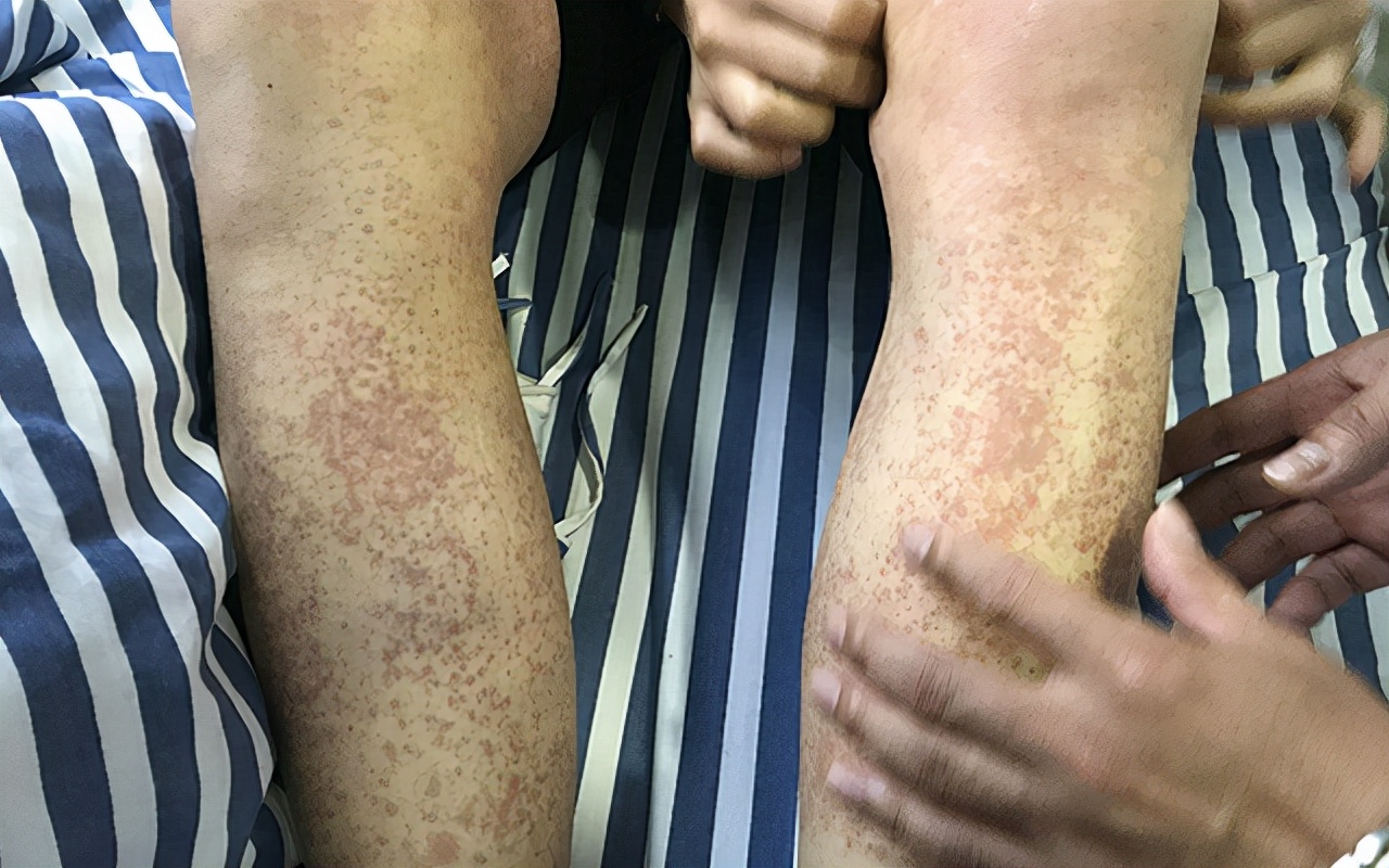 过敏性紫癜颜色变暗但一直不退,过敏性紫癜皮疹一直不退