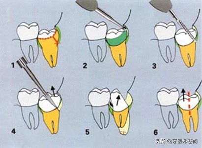 横着长的智齿一定要拔吗要疼多久,智齿横着长压着神经线拔有风险吗