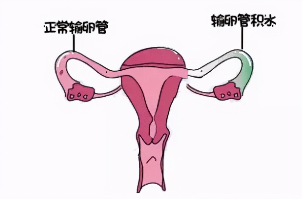 杈撳嵉绠＄暩褰㈡湁鍝簺鐗瑰緛,杈撳嵉绠＄暩褰㈡湁鍝簺鐥囩姸