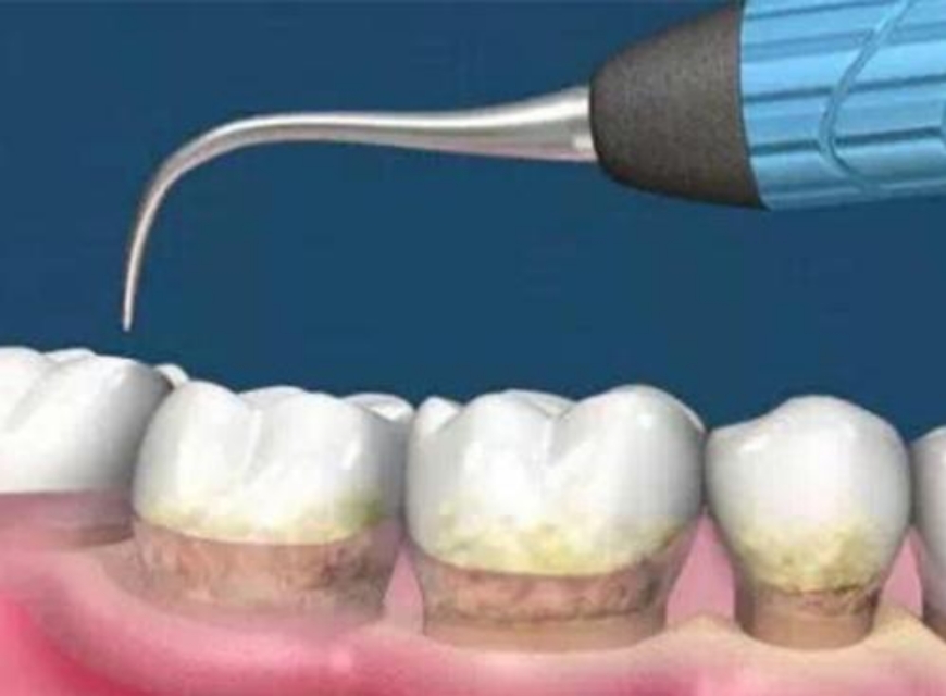 牙齿臭有牙结石怎么去除,牙黄有口臭有牙结石怎么办