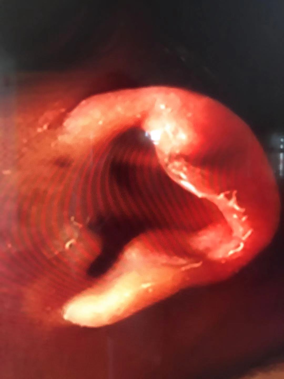 耳朵软骨畸形能矫正吗,新生儿耳朵畸形矫正费用大概多少