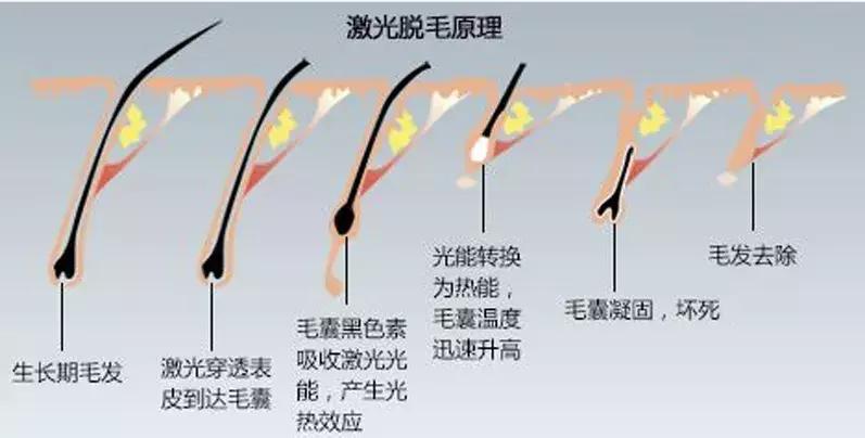 现在美容最火项目,激光脱毛品牌推荐美容院