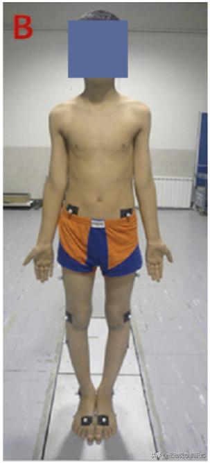 一岁半宝宝o型腿矫正视频,14岁男孩o型腿还能矫正吗