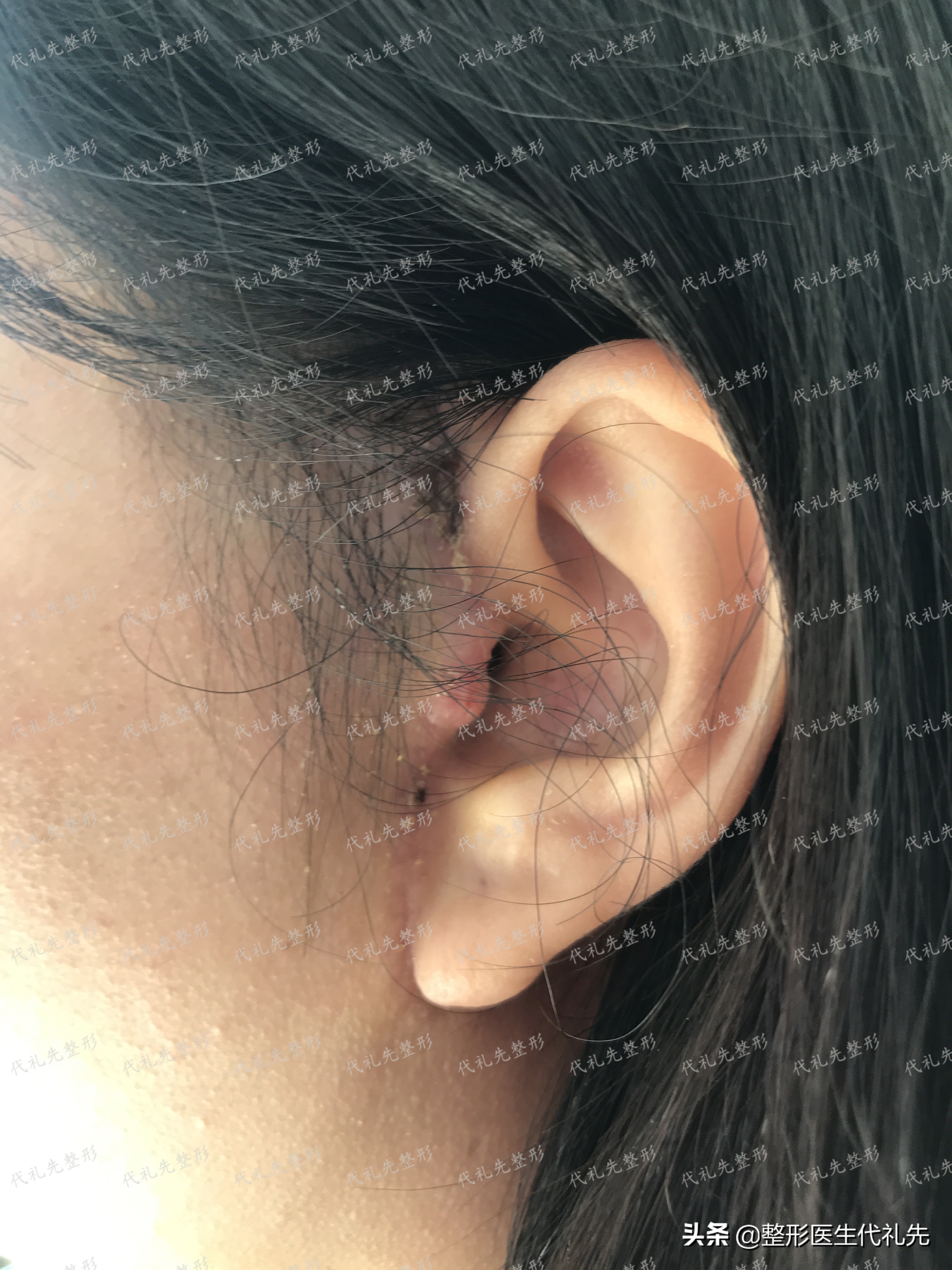 现在最流行的面部提升是什么项目,目前最先进效果最好的面部提升