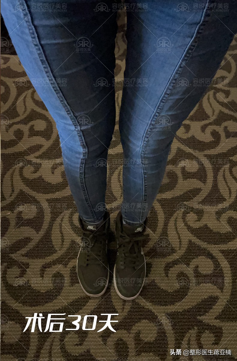 吸脂塑形造就婀娜身材,瘦人美容