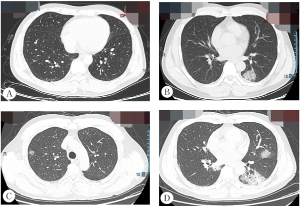 新型冠状病毒感染的肺炎，CT有何特点？和其他病毒性肺炎有何区别