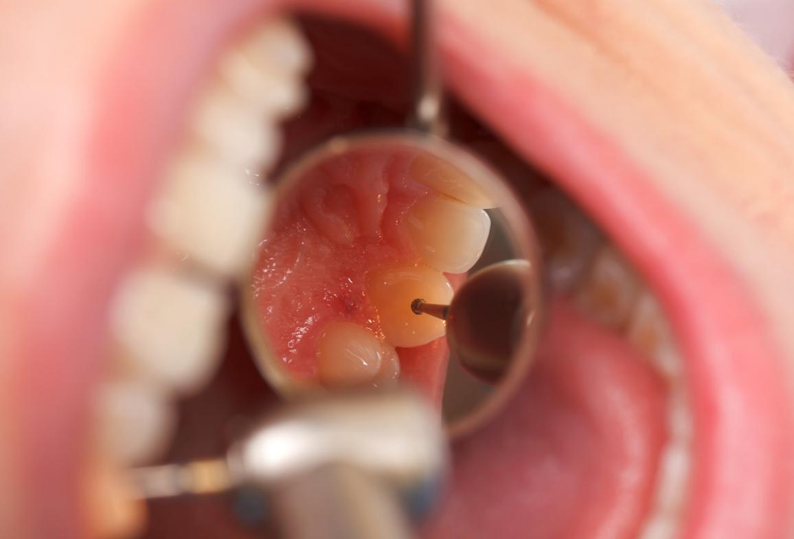 洗牙到底是伤害牙齿还是保护牙齿,洗牙对牙齿伤牙吗