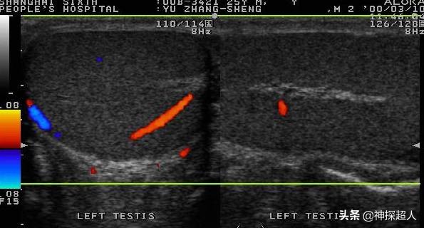 男性“蛋蛋”痛,必须引起重视,特别是一侧突发痛