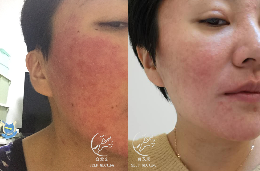 敏感肌修护烂脸推荐,泛红敏感肌修复抗老