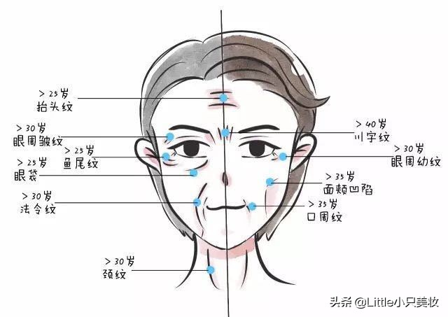 去眼纹打肉毒素吗,去眼纹打多少肉毒素合适