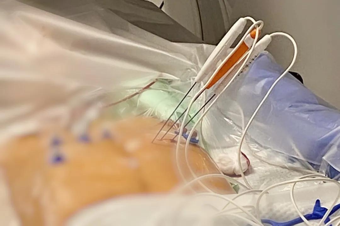 新一代不可逆电穿孔设备|赛诺微在欧洲完成首例IRE手术