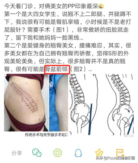 你以为你是翘臀其实是骨盆前倾,你以为的翘臀有可能是骨盆前倾