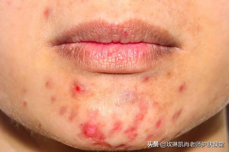 额头脸颊下巴长痘怎么调理,额头脸颊下巴反复长痘如何调理