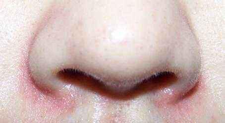 鼻子两侧的皮肤发红是什么原因,鼻子两侧红红的是护肤品引起的吗