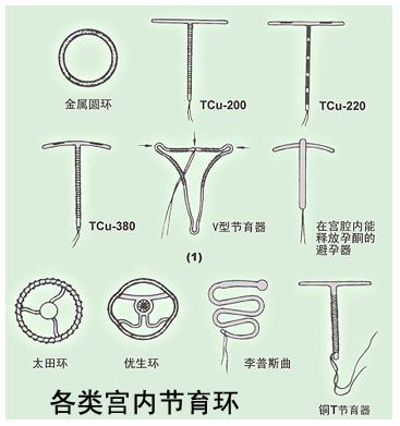 绝经后被遗忘在身体里的节育环，可能是一颗定时*弹炸**
