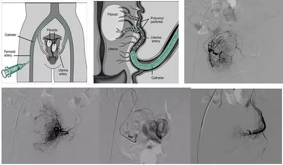 子宫肌瘤一定要手术吗,子宫肌瘤癌变手术可以根治吗