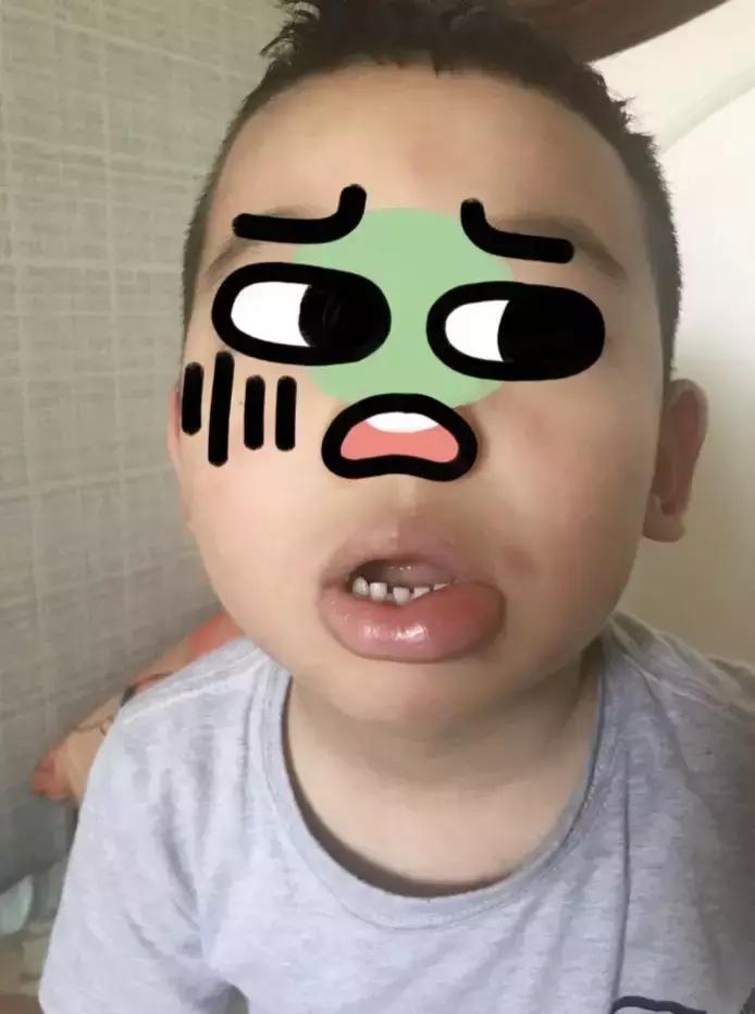 孕妇被蚊子咬了怎么止痒消肿,蚊子咬了止痒消肿最快的办法