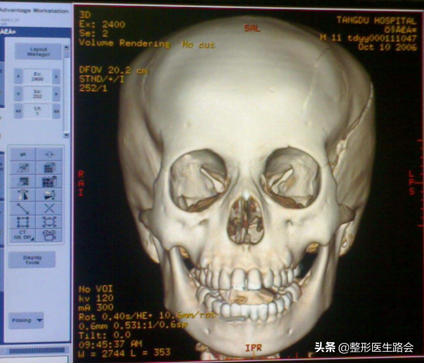 高颧骨下颌宽,颧骨高下颌骨宽上镜怎么办