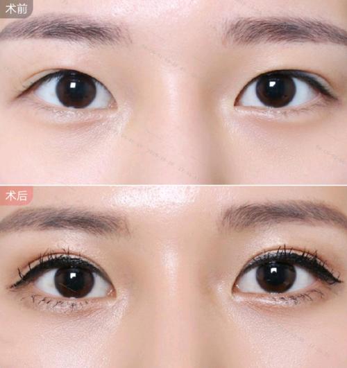 双眼皮埋线优点和缺点,平扇双眼皮优点和缺点