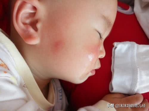宝宝被蚊子叮咬后红肿是什么原因,宝宝被蚊子叮咬红肿特别大怎么办