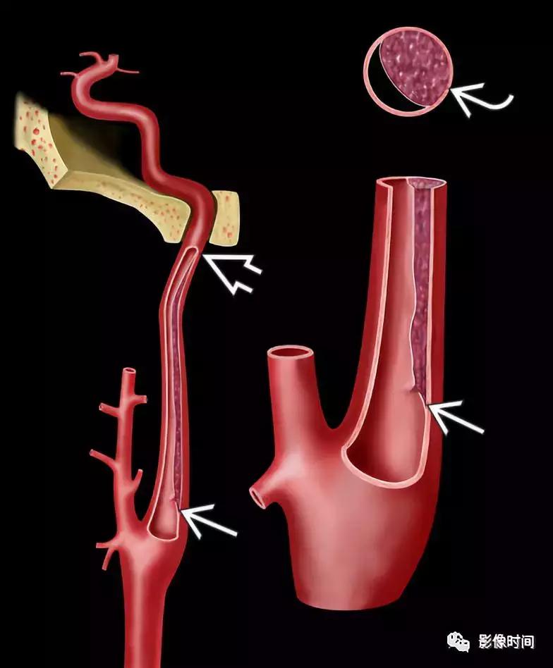 双侧颈动脉鞘间隙多发小淋巴结影,双侧颈动脉间隙多软组织密度结节