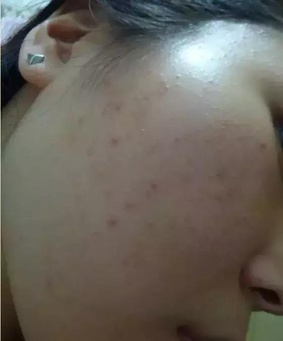 粉刺是什么应该怎么治,粉刺怎么样才算好了