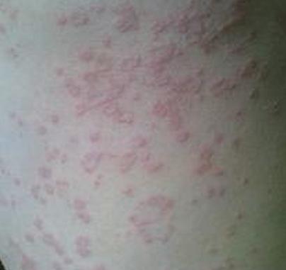 得玫瑰糠疹该如何治最好,红色糠疹和玫瑰糠疹区别
