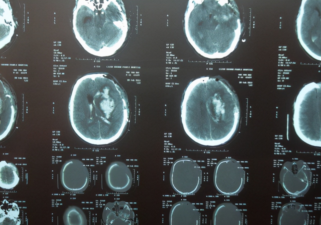 高血压导致脑出血怎么救治,高血压脑出血应该如何救治
