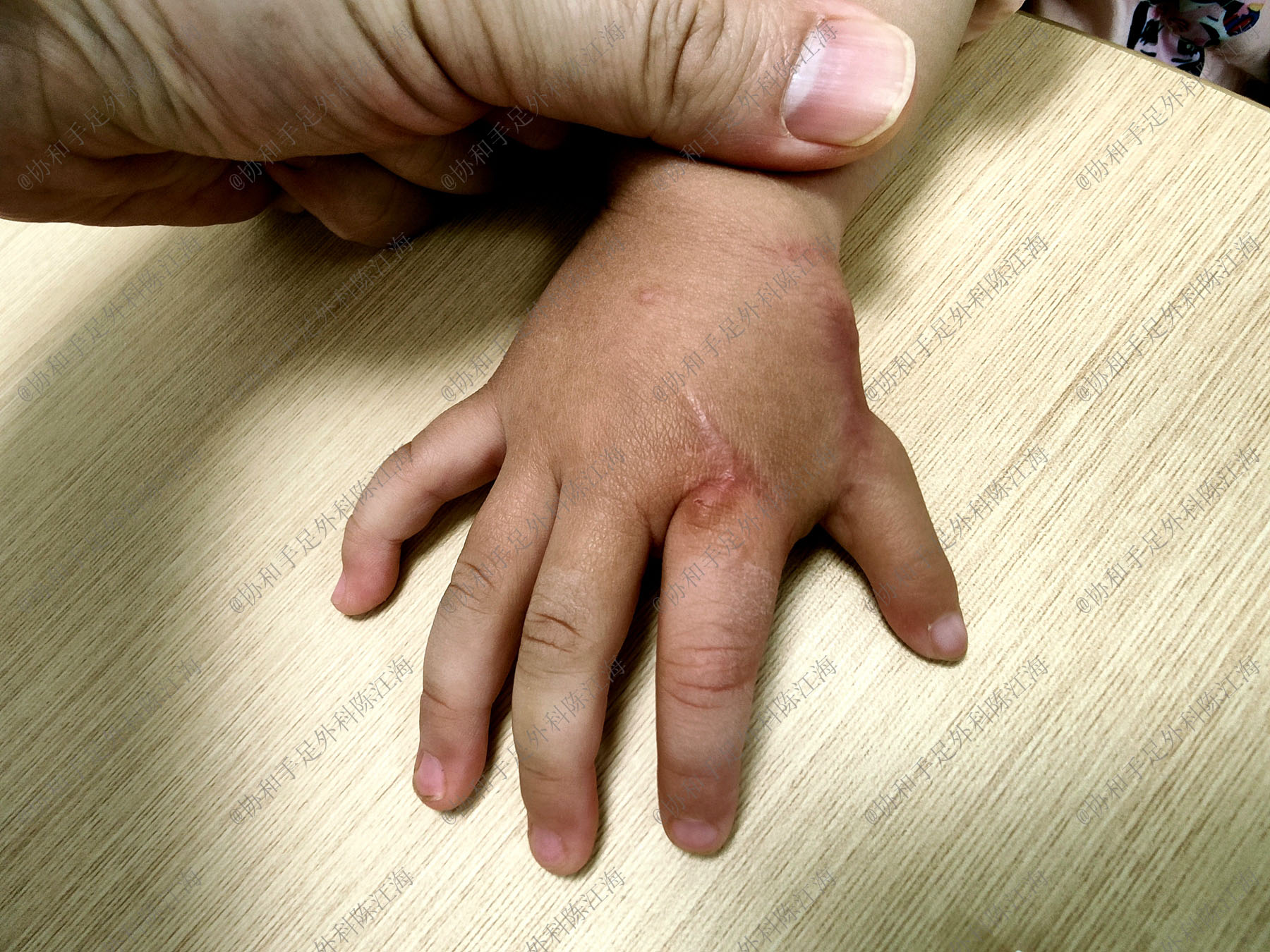 婴儿怎么看手指发育情况,宝宝手指多指是什么原因造成的