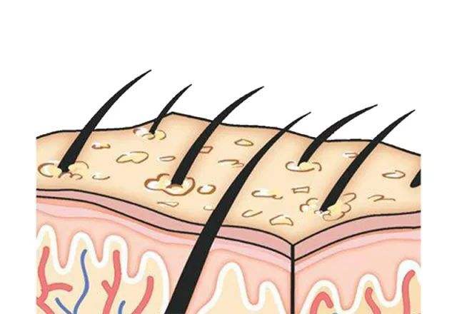 用康王洗头还有头屑怎么办,每隔一天洗头头皮痒有头屑