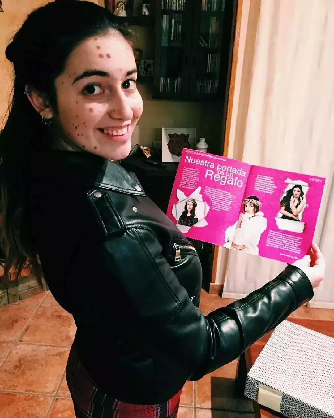 全身黑斑被骂“斑点狗”，身高160的她却成为最美超模…