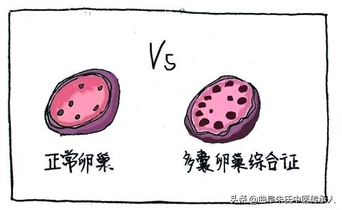 多囊快一年了不怀孕好难啊,得了多囊怀不了孕怎么办