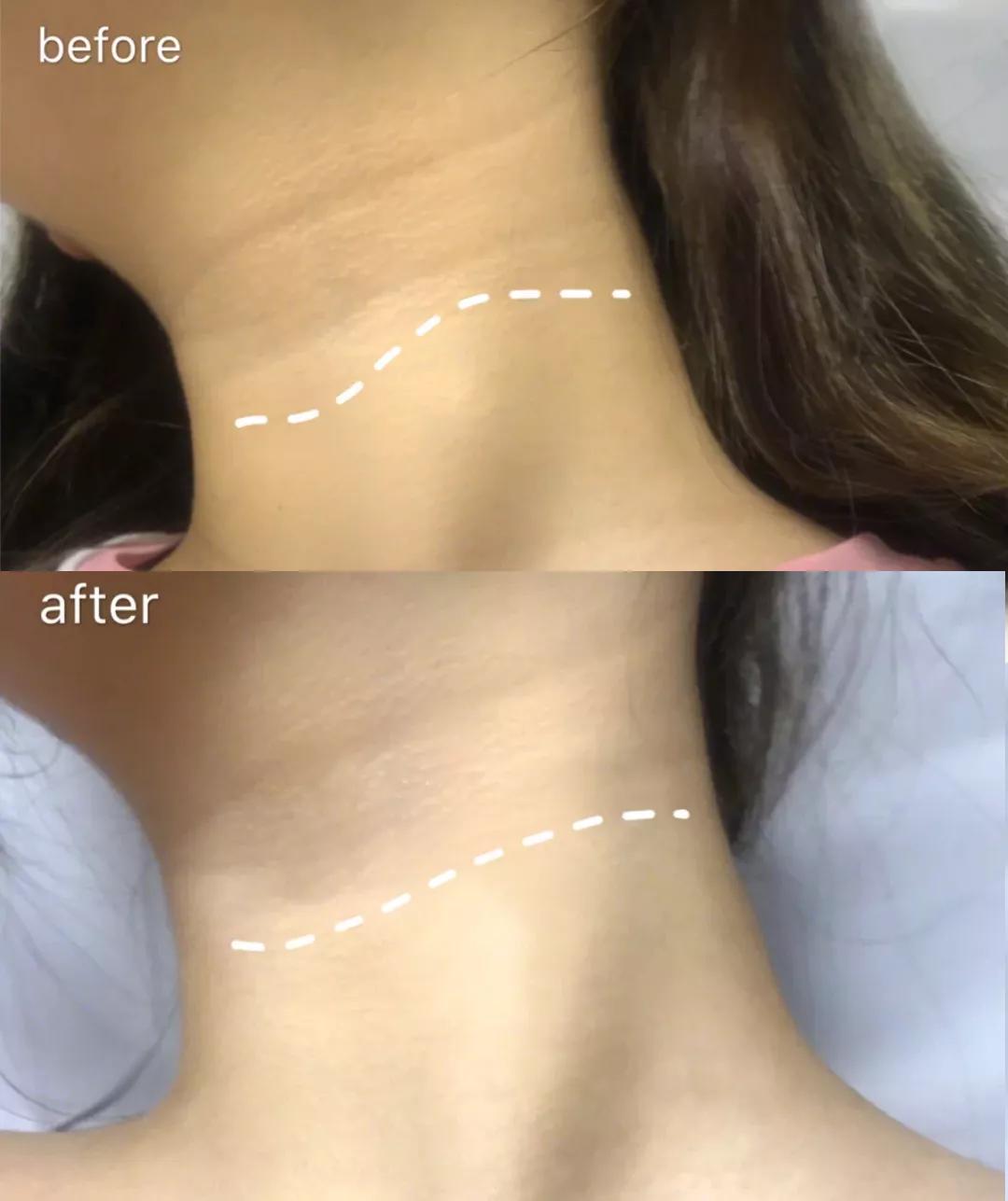 有颈纹和没有颈纹的女人,女人有颈纹怎么办