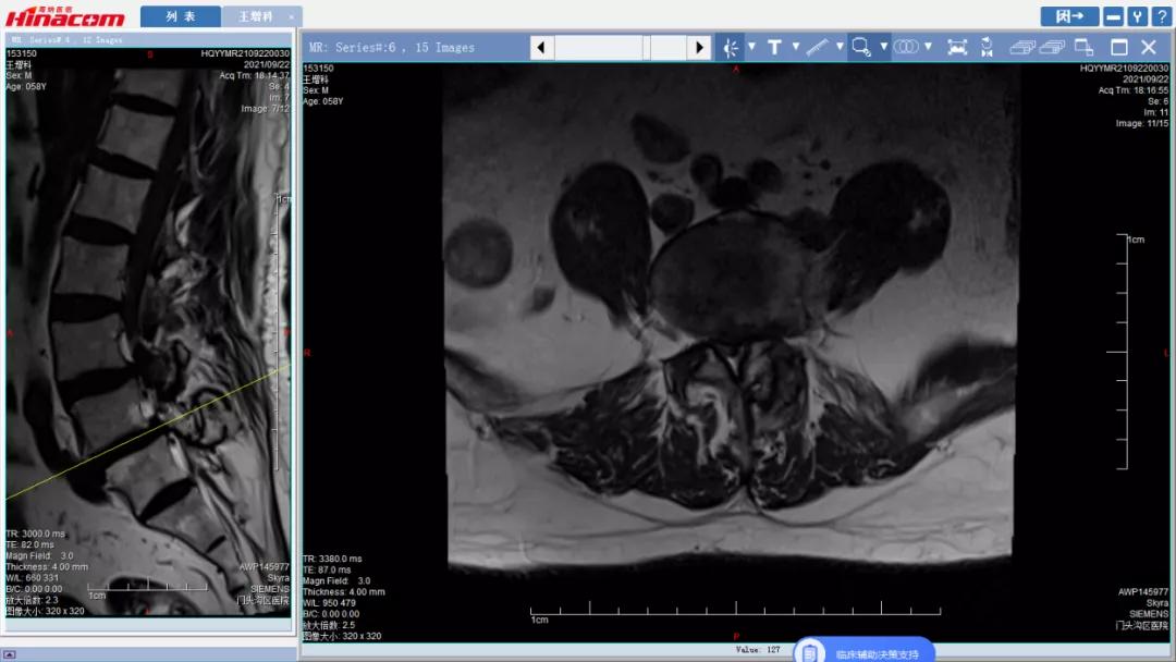 再也不用歪着身子走路了—区医院脊柱中心（骨二科）成功实施腰椎间盘摘除、椎间植骨融合钉棒内固定术