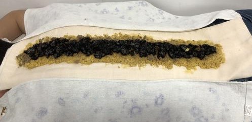 健忘特别严重怎么改善,过度导致的健忘怎么治疗