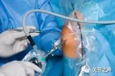 膝关节骨关节炎的阶梯型治疗方案,膝骨关节炎阶梯式治疗