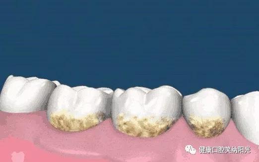 洗牙到底好不好,喷砂洗牙到底好不好