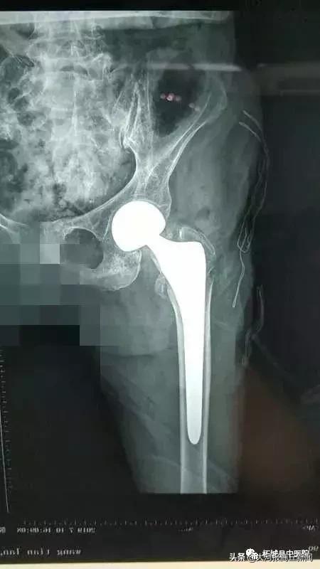 110岁了还能换关节？就在昨天，柘城县中医院北关院区完成了这项创举