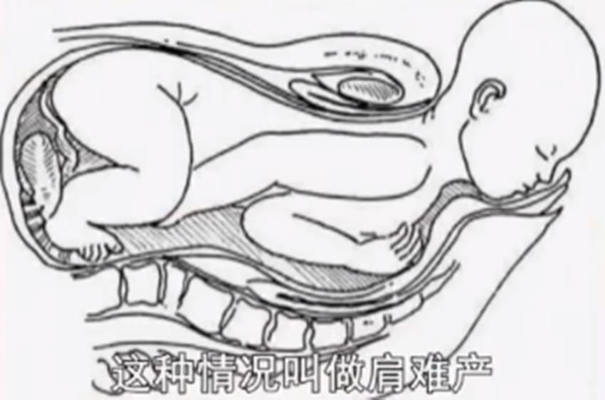 孕妇难产一般是什么原因,难产的孕妇