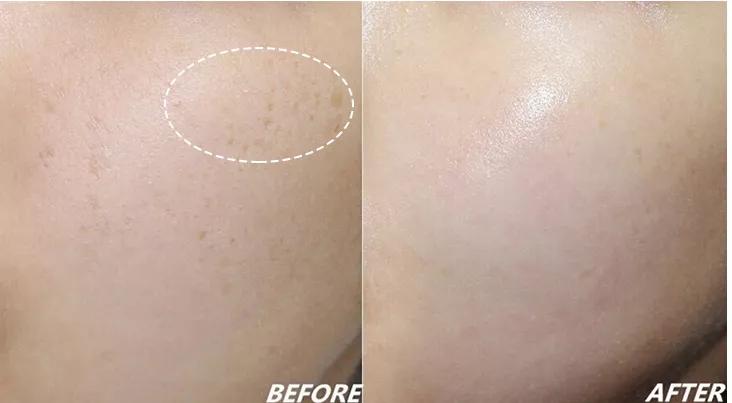 祛色斑的小窍门,色斑严重学会这几招省钱又有效