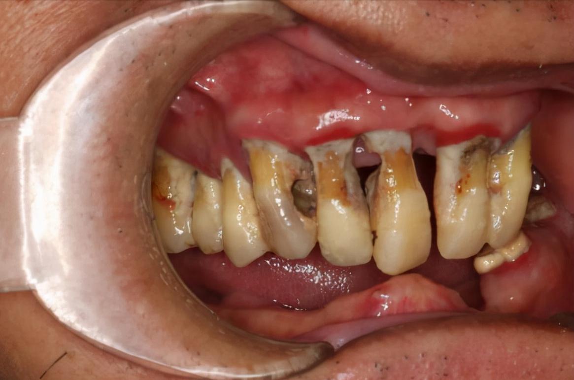 一招解决所有口臭,一招解决口臭困扰