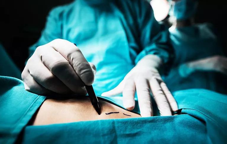 泰国抽脂腹肌,国外腹部抽脂真人演示