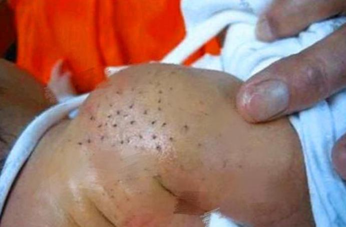 宝宝身上长黑刺妈妈一根根的拔掉,孩子身上长了黑刺