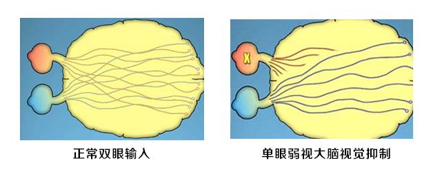 双眼弱视矫正后度数一样怎么训练,科飞视觉对弱视训练有用吗